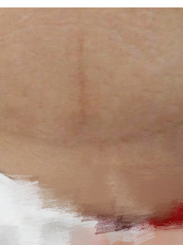 罗玲医生祛疤价格是多少?案例展示和个人简介