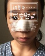 假体隆鼻的介绍、价格、优缺点和注意事项是什么？