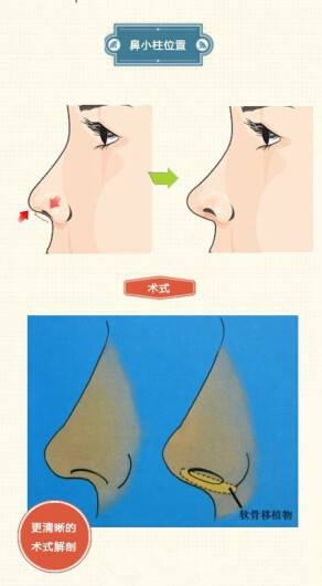 鼻修复的伤害大吗?有哪些鼻修复医生推荐?
