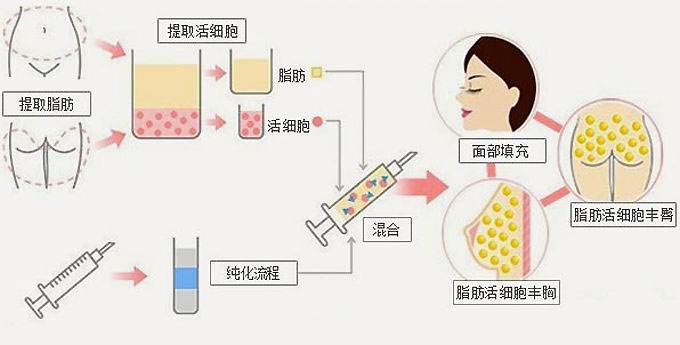 脂肪填充能维持多久?大概要多少钱呢?