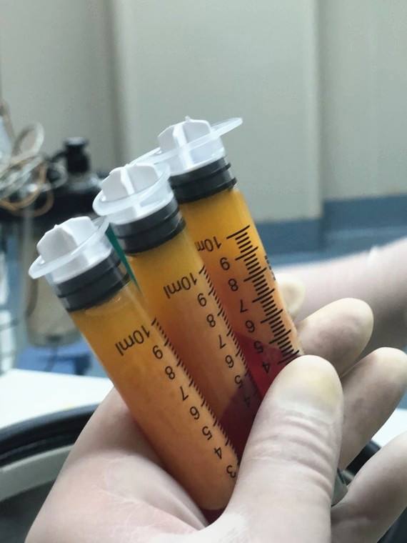 脂肪填充能维持多久?大概要多少钱呢?