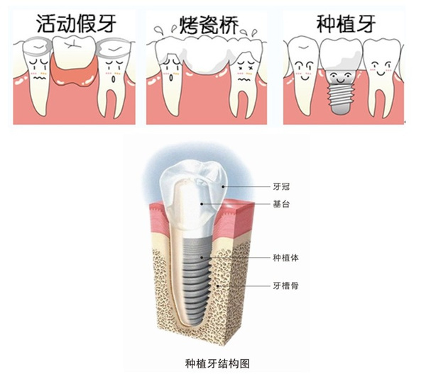 种植牙多少钱一颗?有什么风险和副作用吗?
