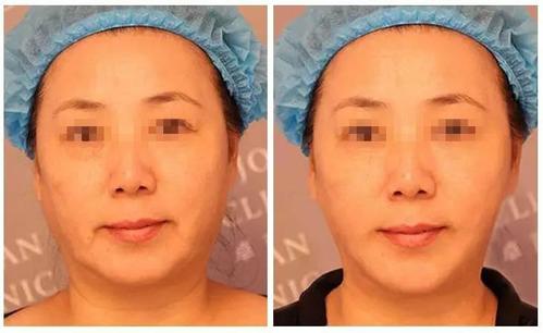 热玛吉和热拉提的区别是什么?有什么副作用吗?