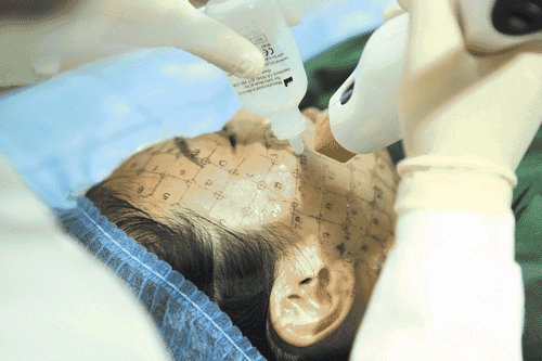 热玛吉和热拉提的区别是什么?有什么副作用吗?