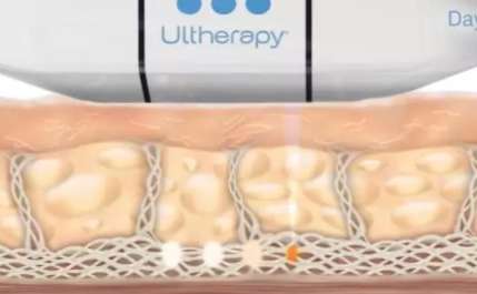 赶紧收藏:在广州有那些医院有热玛吉授权?热玛吉做完到底会不会痛