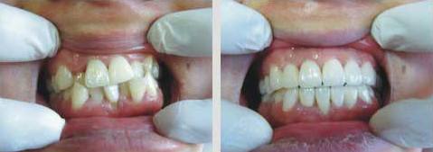 5000块能做烤瓷牙吗?做完果怎么样?