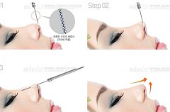 为什么近两年膨体隆鼻的不多？我想可能是这个原因