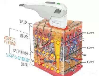 3D的液态微创除皱整形手术大致要多少钱？