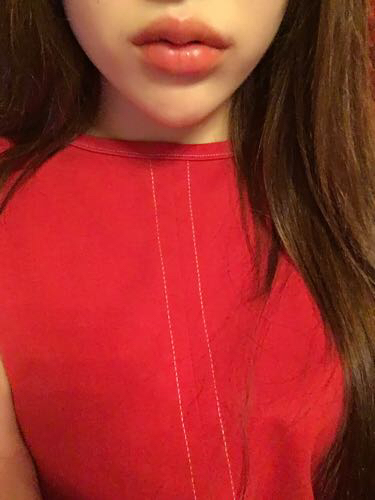 玻尿酸注射嘟嘟嘴淤青了,这个多久会消呢?