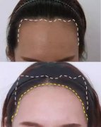 植发际线果怎么样？多少钱？简介和优缺点盘点