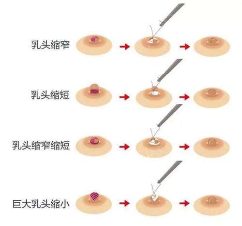 乳房缩小多少钱?果怎么样?简介和优缺点盘点