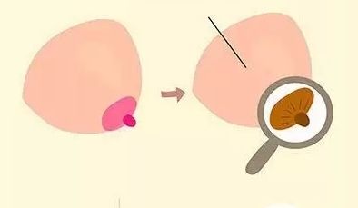 乳房缩小多少钱?果怎么样?简介和优缺点盘点