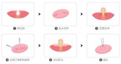 乳头凹陷矫正多少钱？果怎么样？简介和优缺点盘点