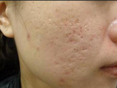 十几年的老痘坑,就这么被治好啦?