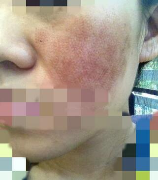 十几年的老痘坑,就这么被治好啦?