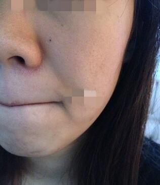 十几年的老痘坑,就这么被治好啦?