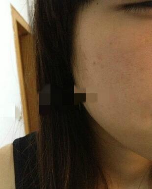 十几年的老痘坑,就这么被治好啦?