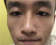 困扰了男友十几年的老痘坑,在武汉艺星就这么治好了?