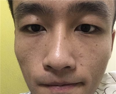 困扰了男友十几年的老痘坑,在武汉艺星就这么治好了?