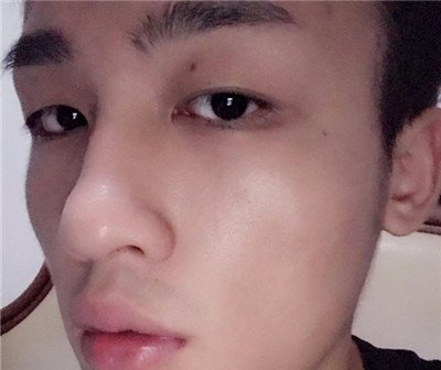 困扰了男友十几年的老痘坑,在武汉艺星就这么治好了?