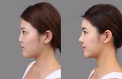 太惊喜|成都钟正强刚出的这一款妈生鼻，手术案例刚出炉