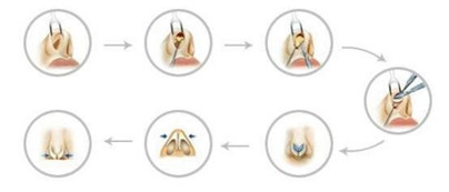 变美分享|半个月的疼痛折磨，换来这么完美的精致鼻