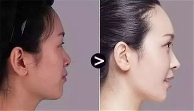 变美分享|半个月的疼痛折磨，换来这么完美的精致鼻