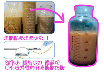 不是很疼|大腿吸脂完后第二天就拆绷带了,但果真的就过于惊喜了