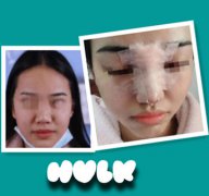 与闺蜜结伴同行，一起在八大处陈江庭医生那进行隆鼻