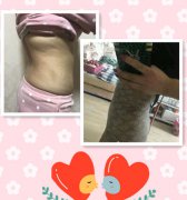 侯典举医生加班给我做腰腹吸脂，果真的太棒