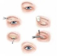 年前做的埋线双眼皮，留疤真的很严重，还好遇