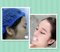 在北京朝阳医院整形范巨峰的鼻修复案例分享和前后对比图片
