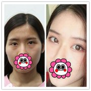 要火啦，在成都美莱脂肪填充全脸两个月术后，果真的无解