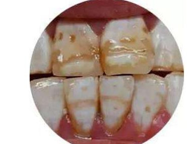 较好的烤瓷牙到底要多少钱,大学生的我能负担