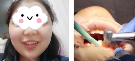 较好的烤瓷牙到底要多少钱,大学生的我能负担