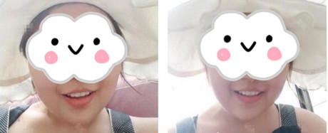 较好的烤瓷牙到底要多少钱,大学生的我能负担