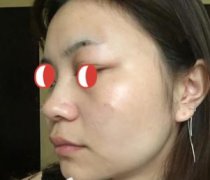 很完美的改善!也不枉费我专门飞到广州教授做