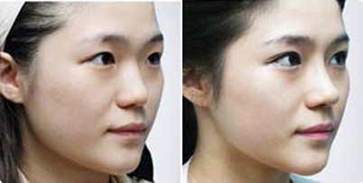 美丽共赏!杭州格莱美中拍手称好的鼻基底抬高的一个变美案例