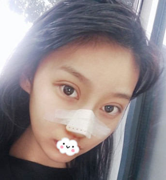 才花2w多在厦门莫琳娜那做的鼻整形,15天后真的是变了一个脸