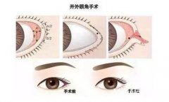 在上海做的开外眼角全过程案例，本少女闪亮登场