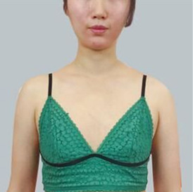 在北京叶子整形做的隆胸,让我直接变成“大”白挺