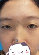 在南宁华美做完双眼皮，我也变成了一个爱笑的眼睛了