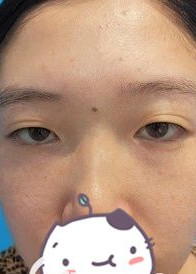 在南宁华美做完双眼皮,我也变成了一个爱笑的眼睛了