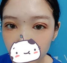 在南宁华美做完双眼皮,我也变成了一个爱笑的眼睛了