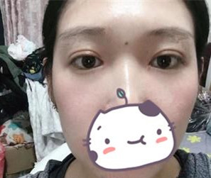 在南宁华美做完双眼皮,我也变成了一个爱笑的眼睛了