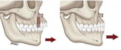 天包地嘴型是一定得正颌吗?正颌手术会不会特别危险呀