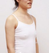 在刘成胜医生那做隆胸，术后秒变“大”女孩，我的亲历分享