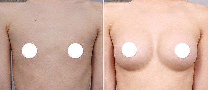 假体隆胸的介绍、价格、优缺点和注意事项是什么?