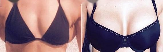 假体隆胸的介绍、价格、优缺点和注意事项是什么?