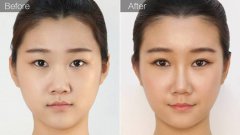 多方面盘点——隆鼻材料到底该怎么去选？